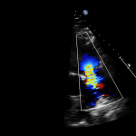 Read more about the article PSAX RVOT Colour
