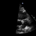Read more about the article PSAX RVOT