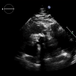 Read more about the article PLAX RVOT