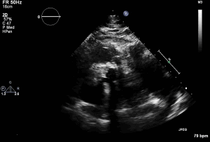 PLAX RVOT