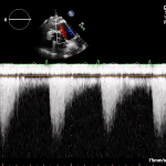 Read more about the article PLAX RVOT CW