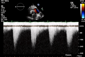 PLAX RVOT CW