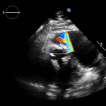 Read more about the article PLAX RVOT Colour