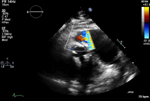 PLAX RVOT Colour