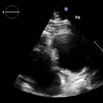 Read more about the article PLAX RVOT PA