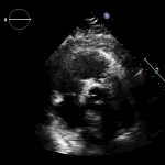 Read more about the article PSAX RVOT