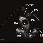 Read more about the article 2 PSAX RVOT
