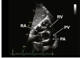 5 Subcostal RVOT