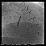 Thrombosed Mitral Valve