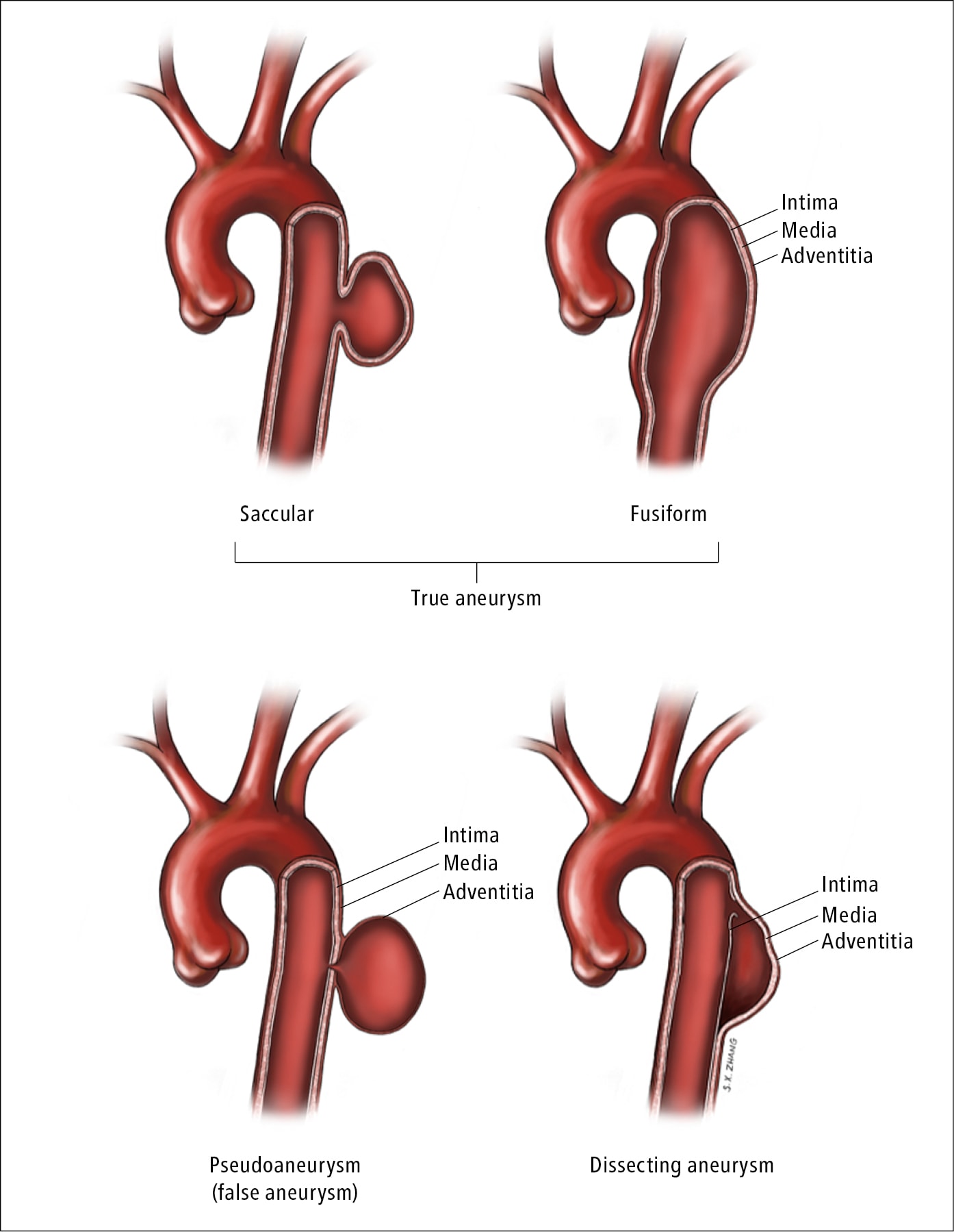 Aortopathy Cardio Guide