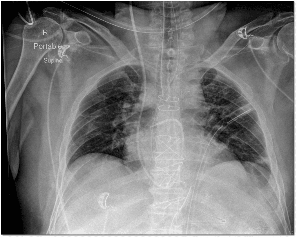 Pulmonary Artery Catheterization Cardio Guide