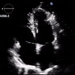 Read more about the article PFO