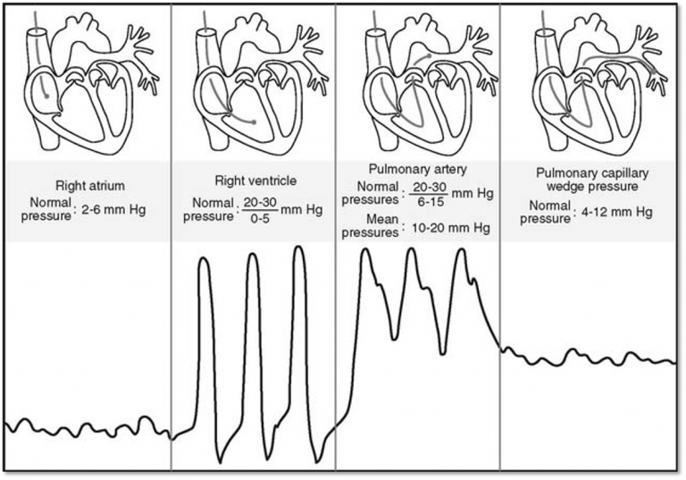 Pulmonary Artery Catheterization Cardio Guide